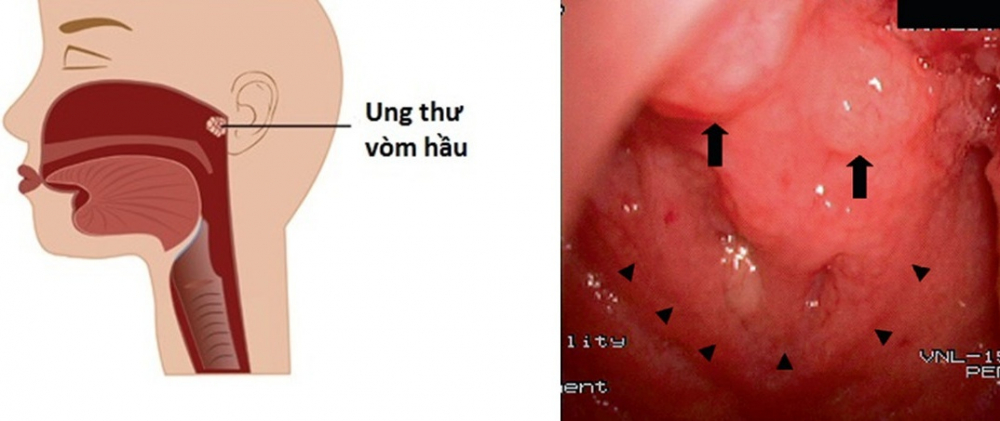 ung-thu-vom-hong-kho-phat-hien-som