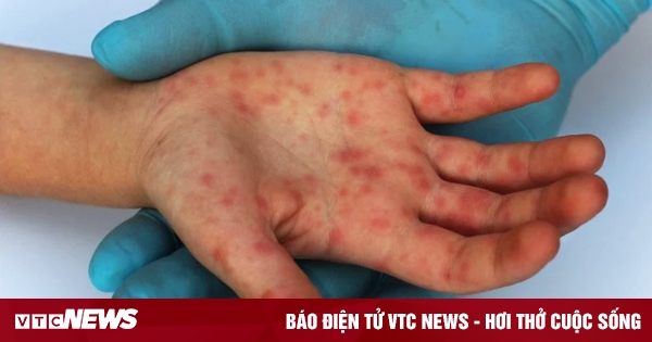 TP.HCM ghi nhận thêm 1 ca mắc đậu mùa khỉ