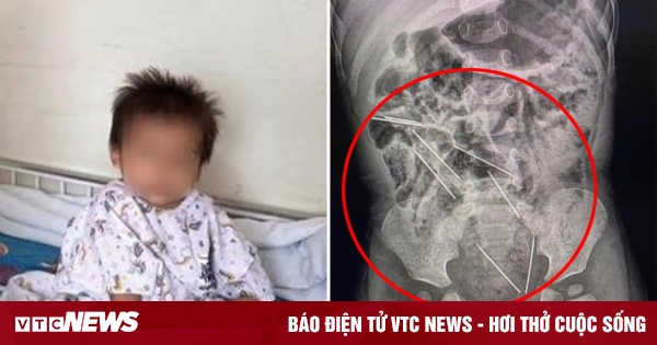 Nuốt phải 8 cây kim tiêm dành cho gia súc, cậu bé 2 tuổi may mắn được cứu