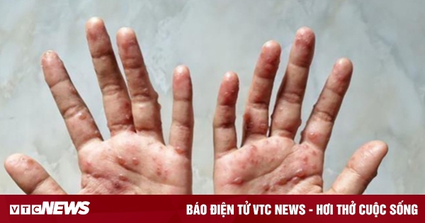 Cách phòng và điều trị bệnh đậu mùa khỉ