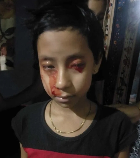 Bệnh lạ khiến bé gái 8 tuổi 'khóc' ra máu - 1