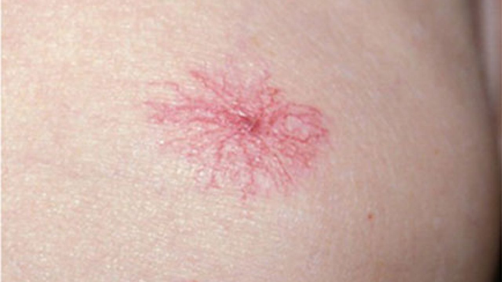 Uống rượu xong có 4 biểu hiện này bạn cần đi khám xơ gan ngay - 3