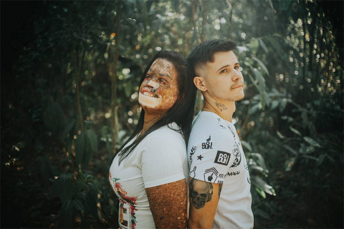 Chàng trai trẻ đẹp quyết cưới bằng được cô gái xấu xí bị bệnh lạ - 1