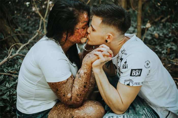 Chàng trai trẻ đẹp quyết cưới bằng được cô gái xấu xí bị bệnh lạ - 2