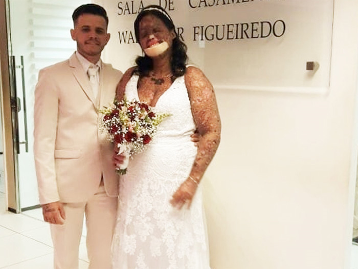 Chàng trai trẻ đẹp quyết cưới bằng được cô gái xấu xí bị bệnh lạ - 4