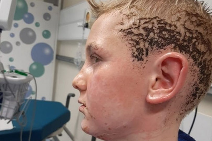 Bắt chước trò nghịch dại trên Youtube, cậu bé 10 tuổi bỏng nặng - 1