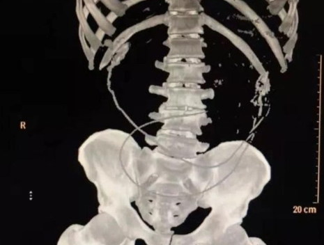 Nuốt 2 con lươn để chữa táo bón, người đàn ông suýt chết - 1