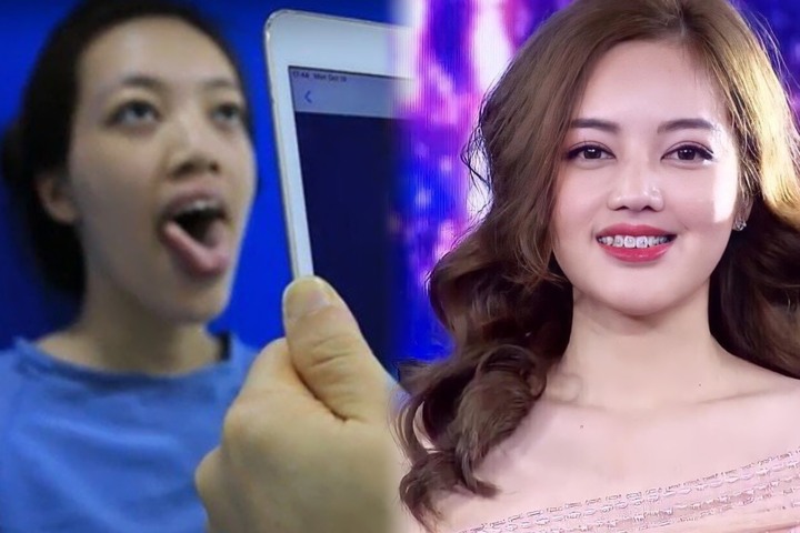 21 năm sống với chiếc lưỡi khổng lồ, 9X Hải Dương lột xác sau 4 tháng dao kéo