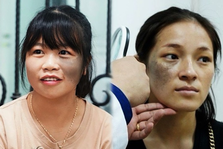 Nỗi khổ của người mẹ trẻ bị vết bớt chiếm nửa khuôn mặt