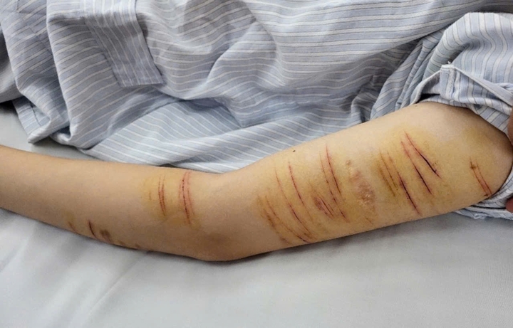 Tự rạch tay để giải tỏa stress: Bác sĩ khuyến cáo căn bệnh nguy hiểm