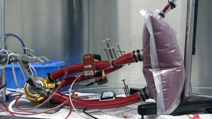 Người đàn ông sống sót 100 ngày bằng quả tim titan