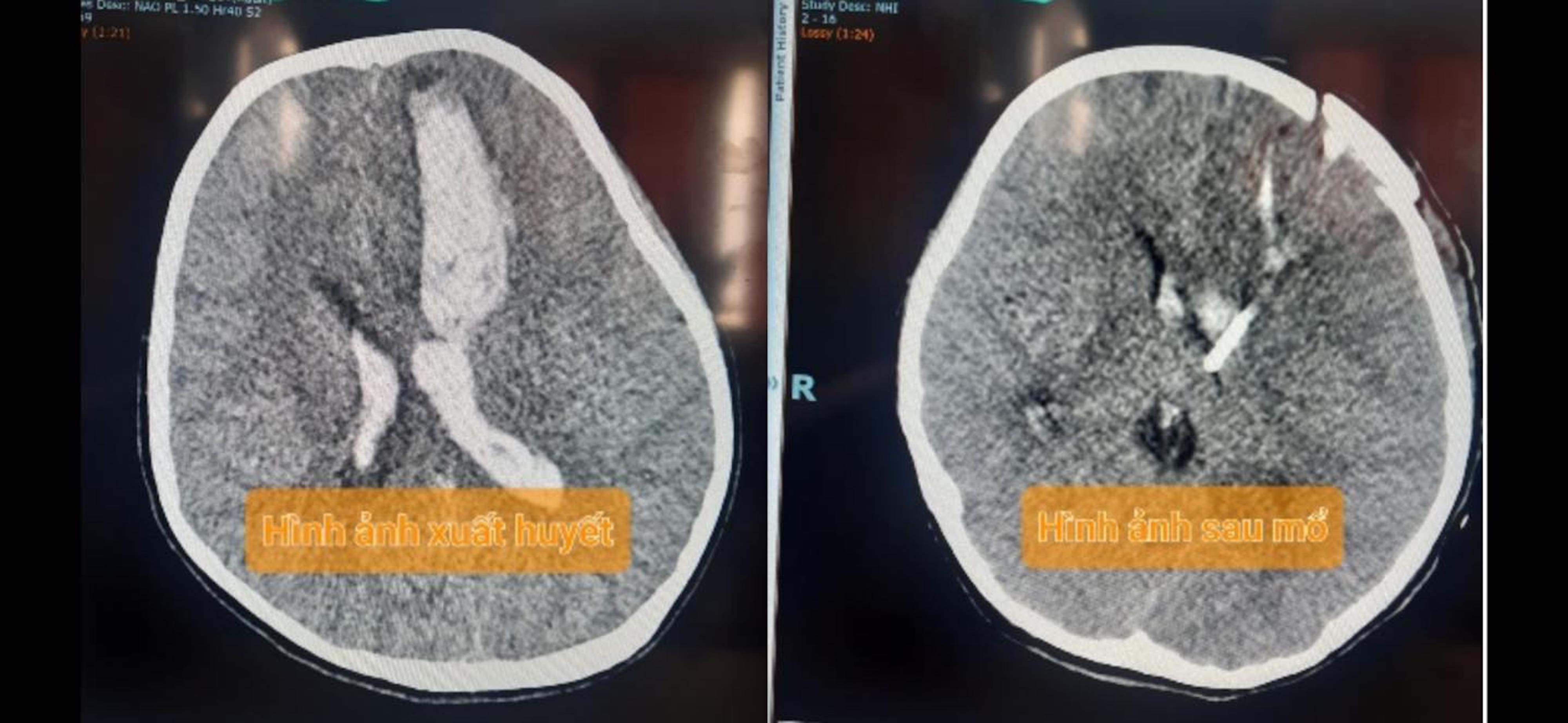 Cứu 3 trẻ xuất huyết não do vỡ mạch máu