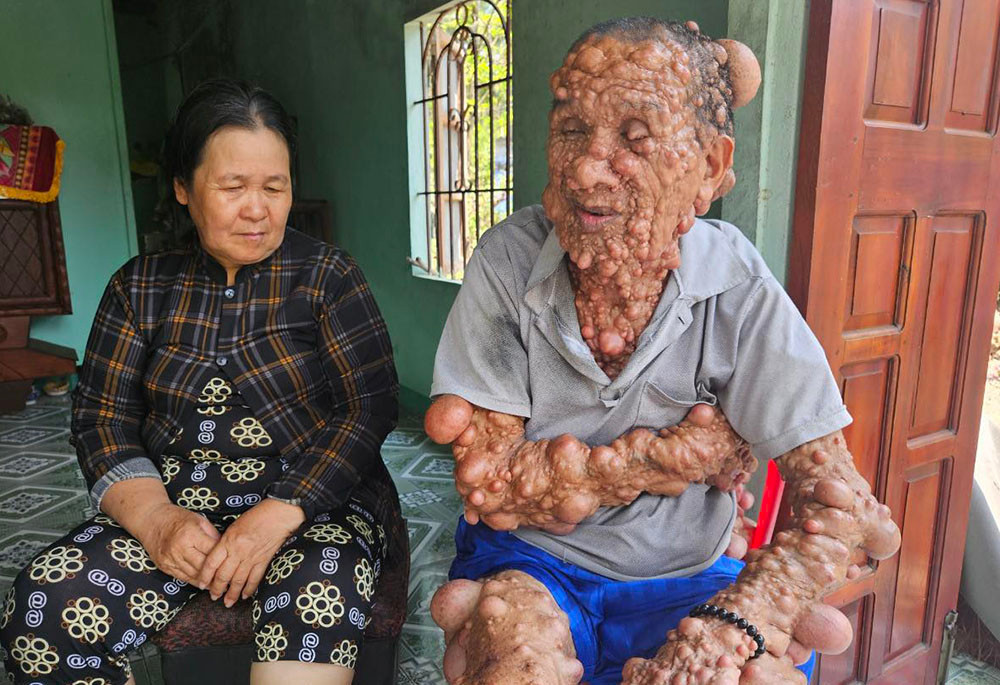 Người phụ nữ nghèo bất lực nhìn chồng con đau đớn vì khối u chiếm toàn bộ cơ thể