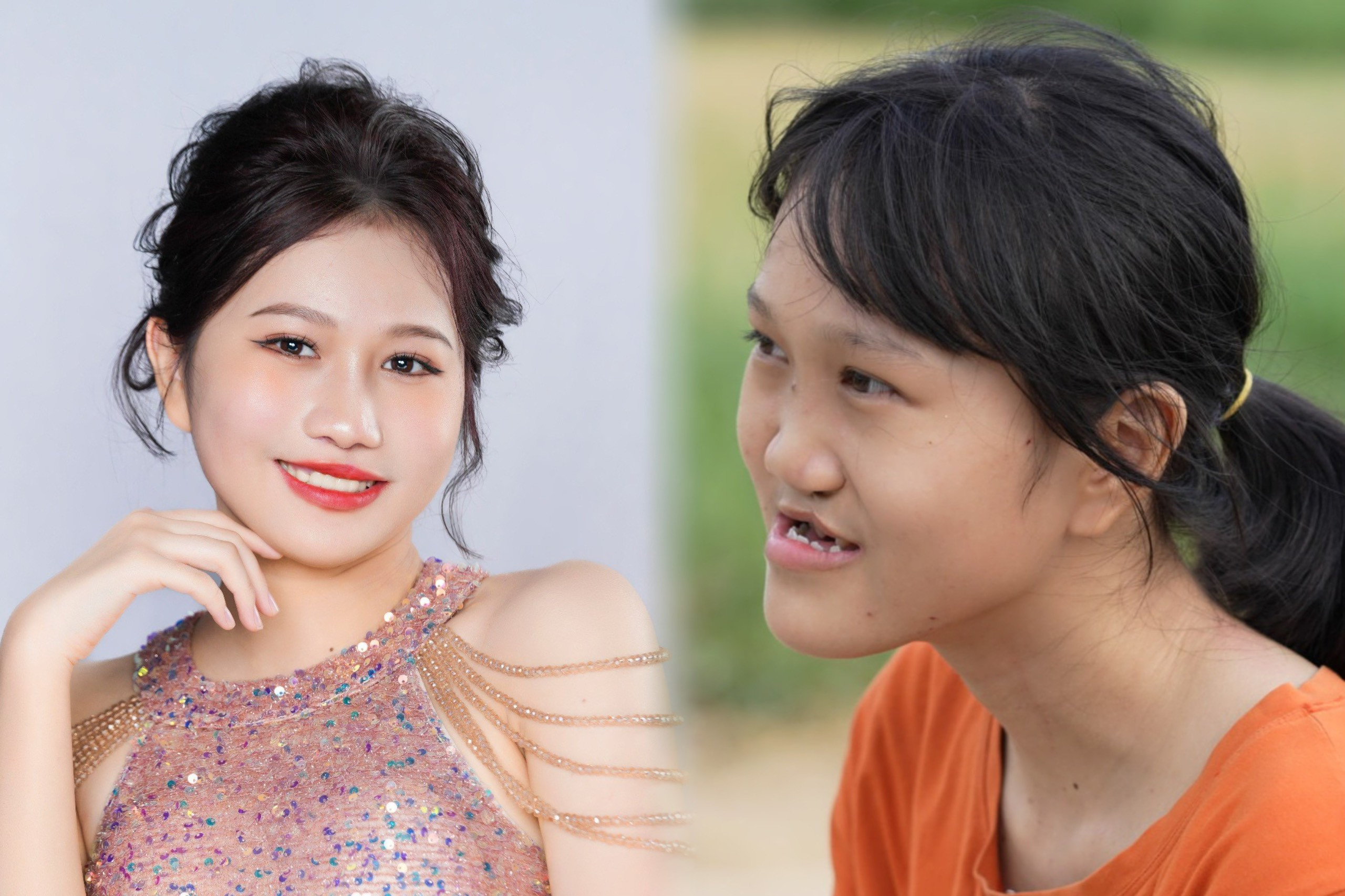 Cuộc sống của cô gái hở hàm ếch sau 2 lần mổ tái tạo gương mặt