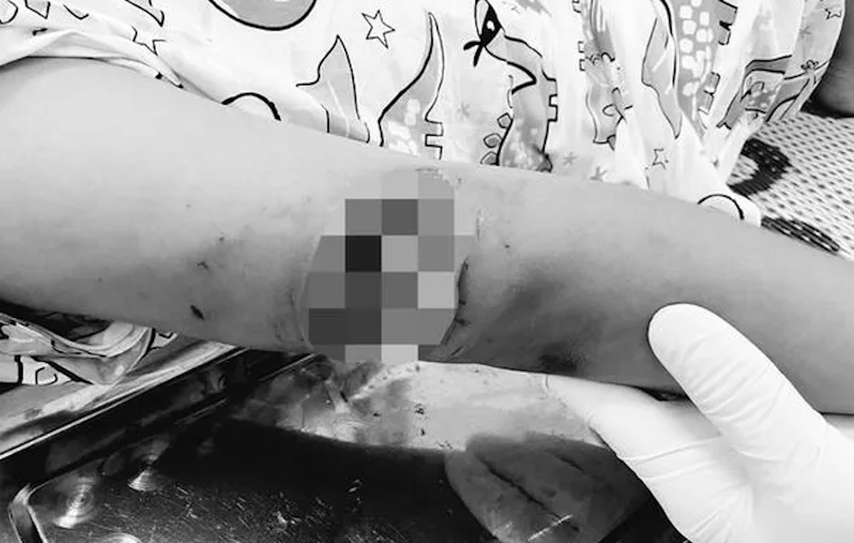 Sang hàng xóm chơi, bé gái 7 tuổi bị chó dữ tấn công