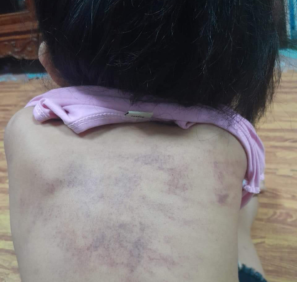 Bé 5 tuổi tím bầm lưng: Phân công 3 giáo viên phụ trách lớp làm nhiệm vụ khác