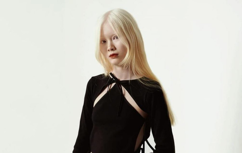 Nữ sinh mắc bạch tạng thành mẫu ảnh đẹp khiến nhiều người ngỡ ngàng