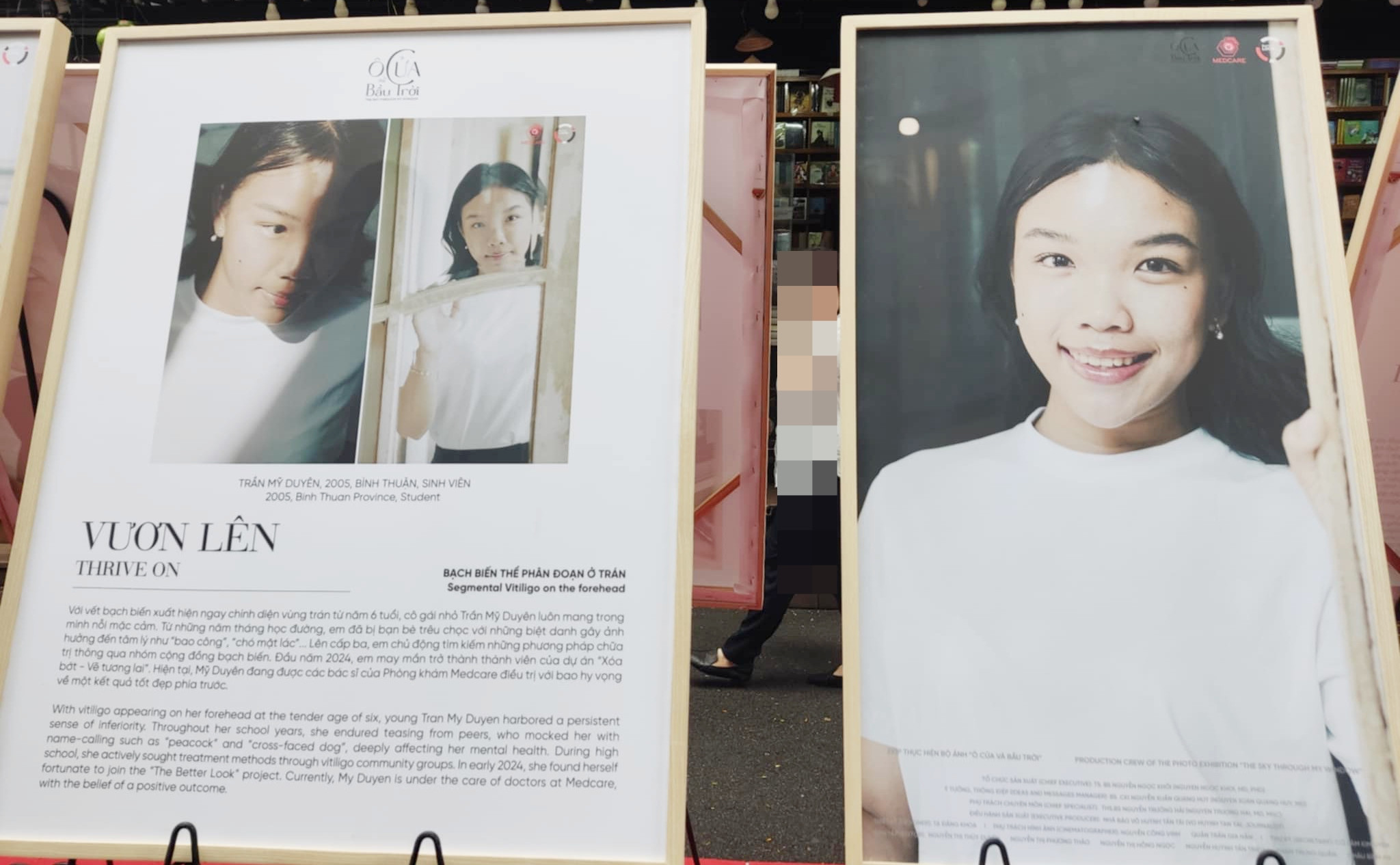 Cuộc sống mới của cô gái mắc bệnh bạch biến từng bị bạn bè xa lánh