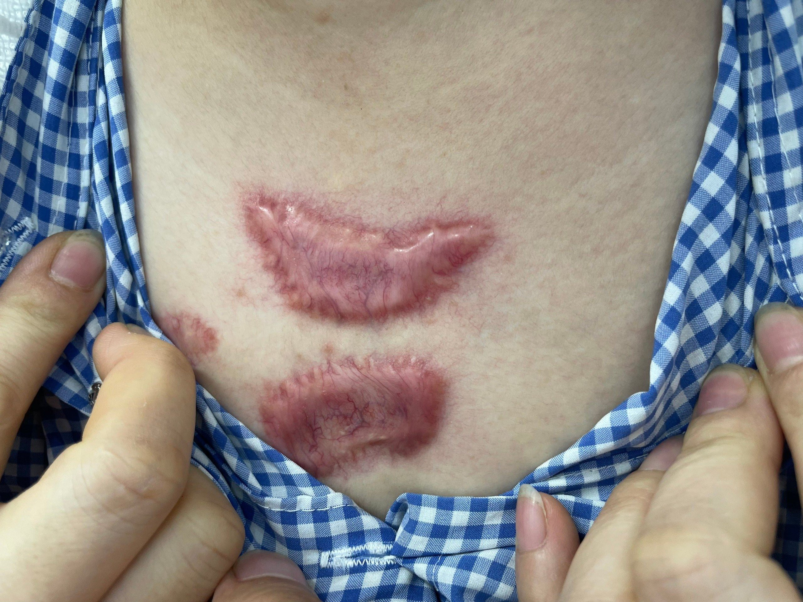 Chi hàng chục triệu trị sẹo, kết quả gặp biến chứng phải tìm bác sĩ