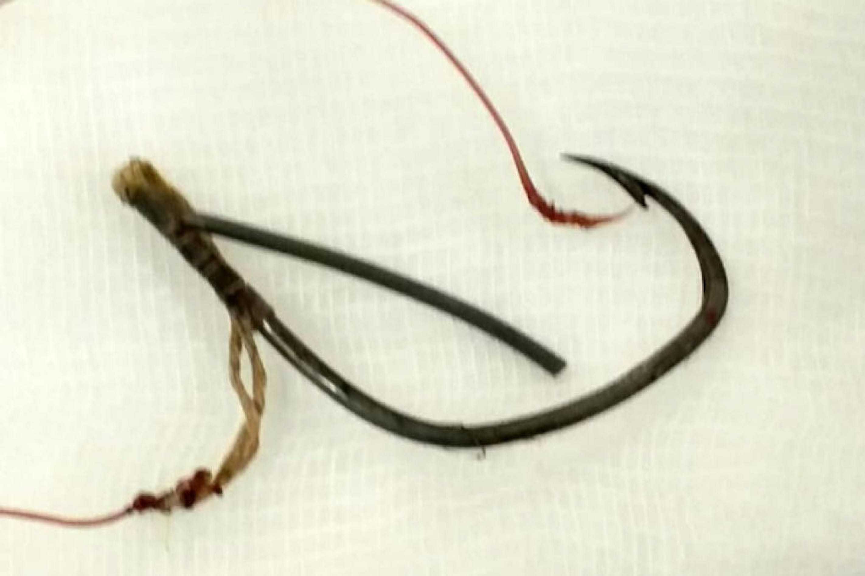 Người phụ nữ bị lưỡi câu cá găm vào mắt 