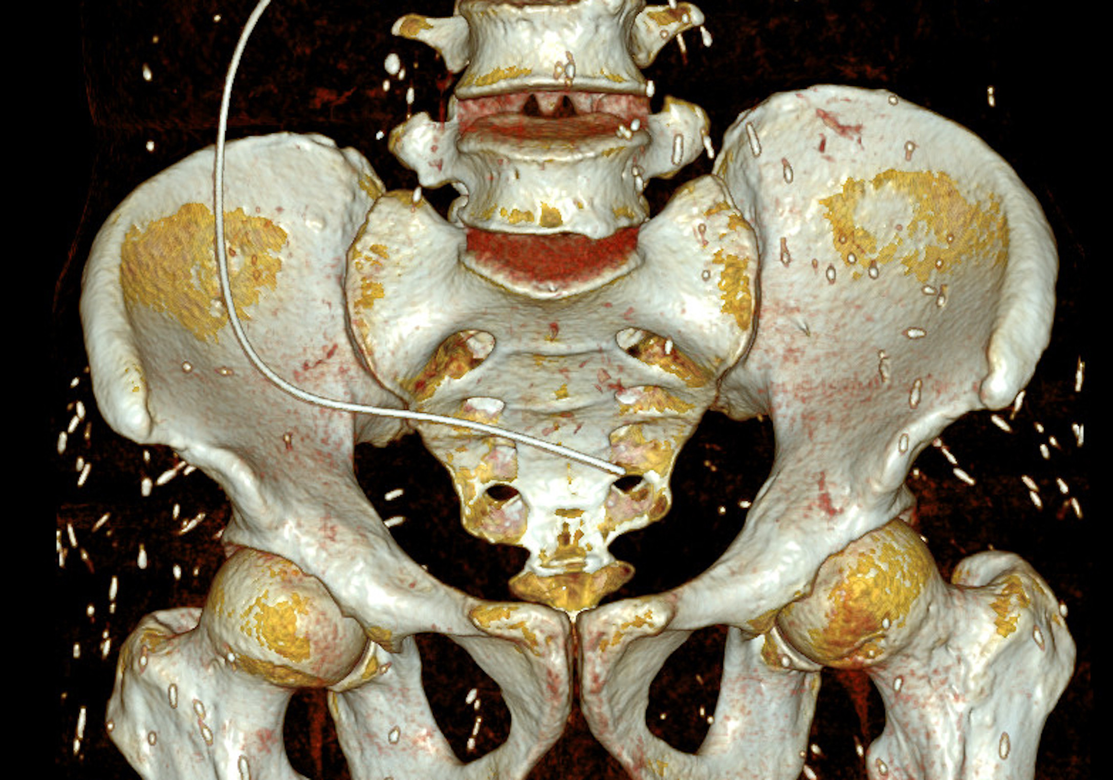 Đi khám do đau bụng, phát hiện sán ký sinh khắp cơ thể