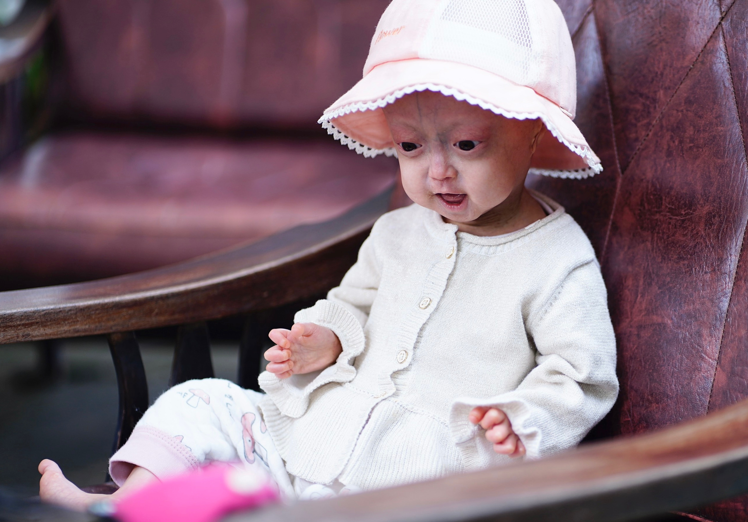 Cuộc sống hiện tại của bé gái mắc chứng 'vừa chào đời đã già'