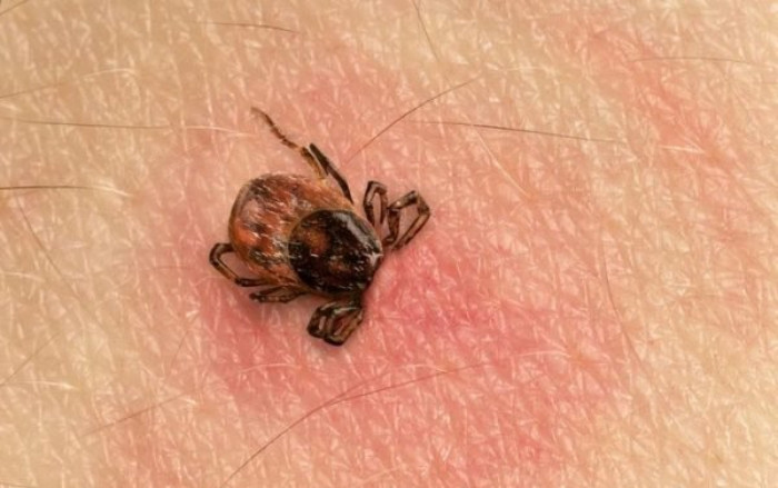 Suy đa tạng do bị mò đốt