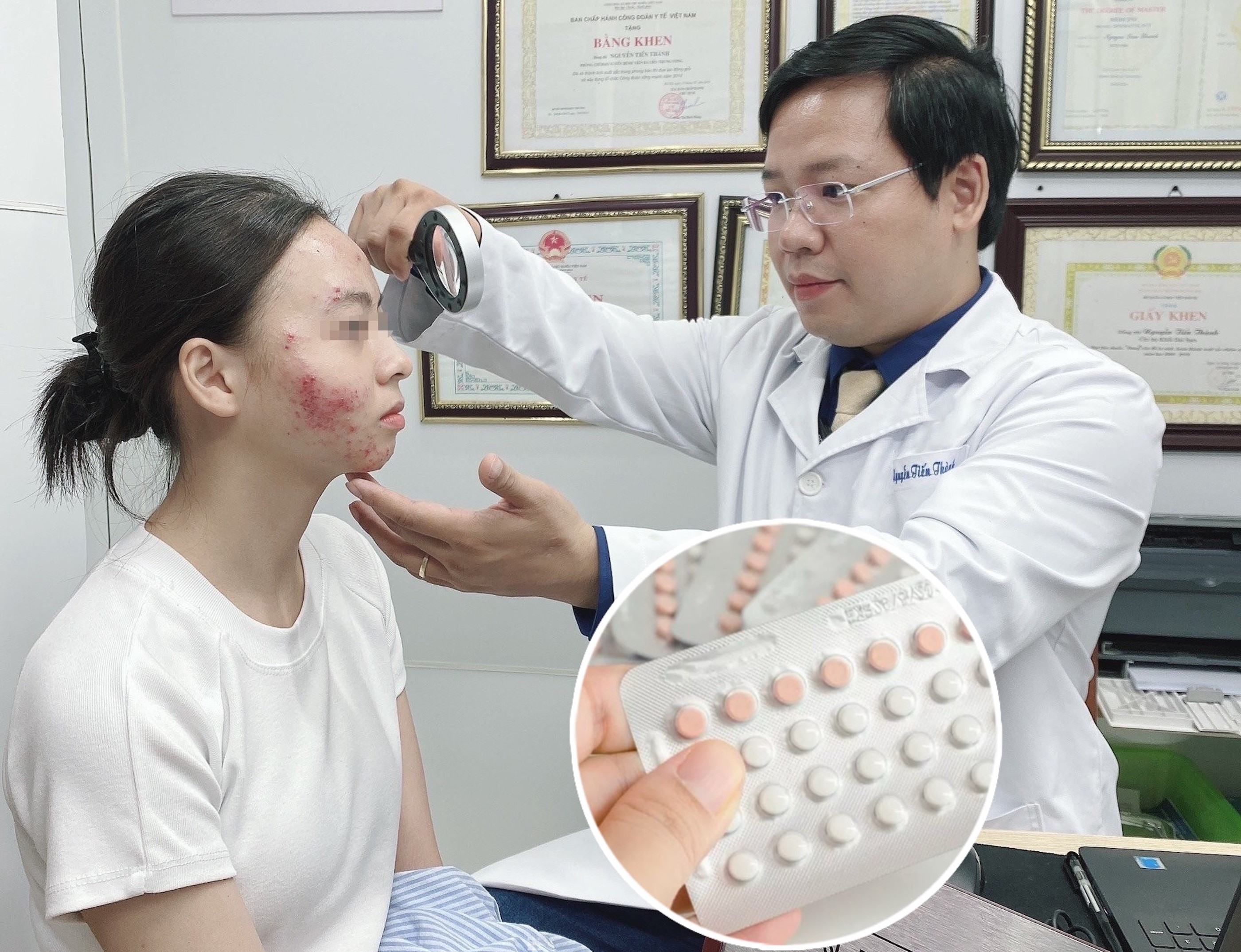 Rước họa vào thân sau khi uống thuốc tránh thai khẩn cấp để trị mụn