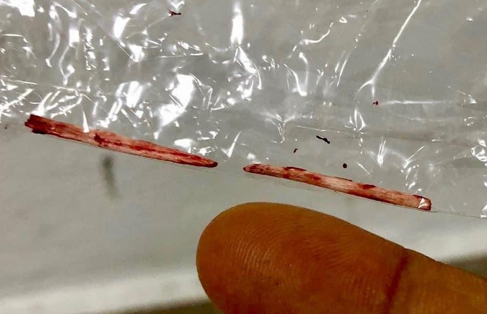 Sốt 7 ngày không giảm, đi khám phát hiện 'vật thể lạ' trong gan