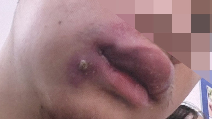 Nhập viện cấp cứu sau khi tự nặn mụn