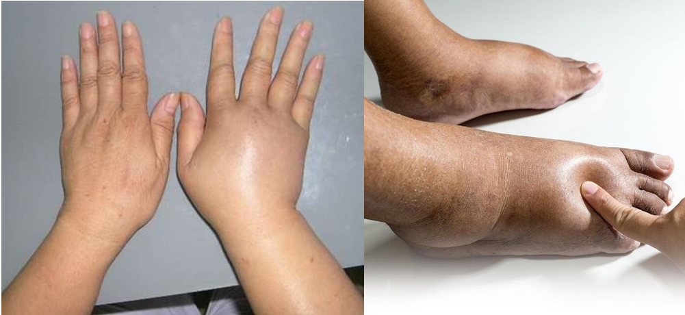 Chân tay phù nề, kiểm tra ngay sức khỏe của quả thận