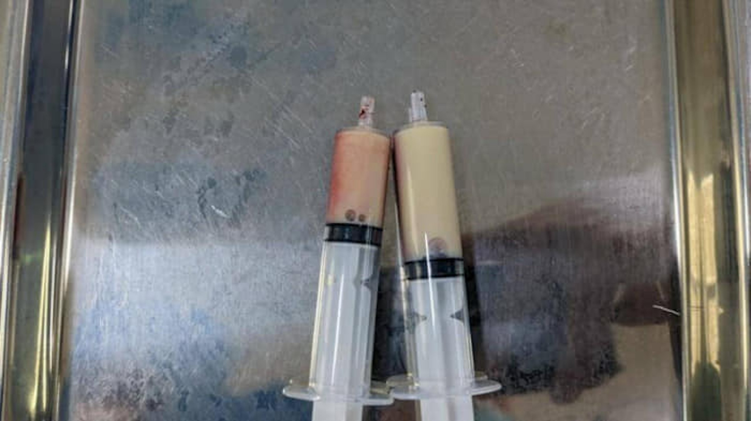 Cấp cứu người đàn ông bị mỡ máu 'đông đặc'