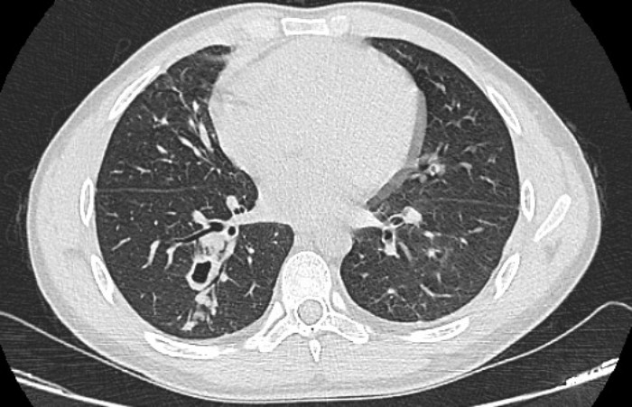 Ho ra máu, đi khám phát hiện sán làm tổ trong phổi