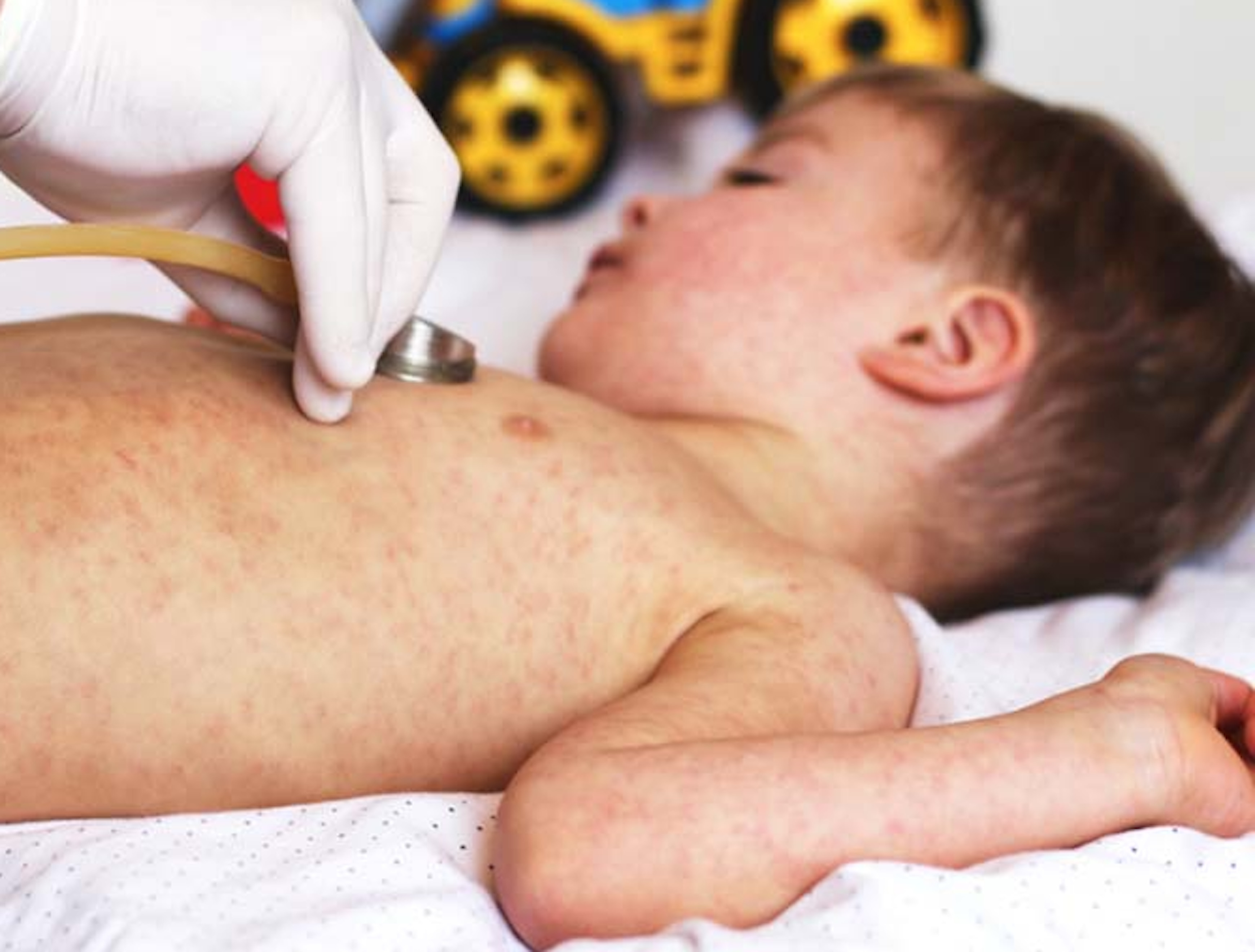 Bệnh sởi nguy hiểm thế nào?