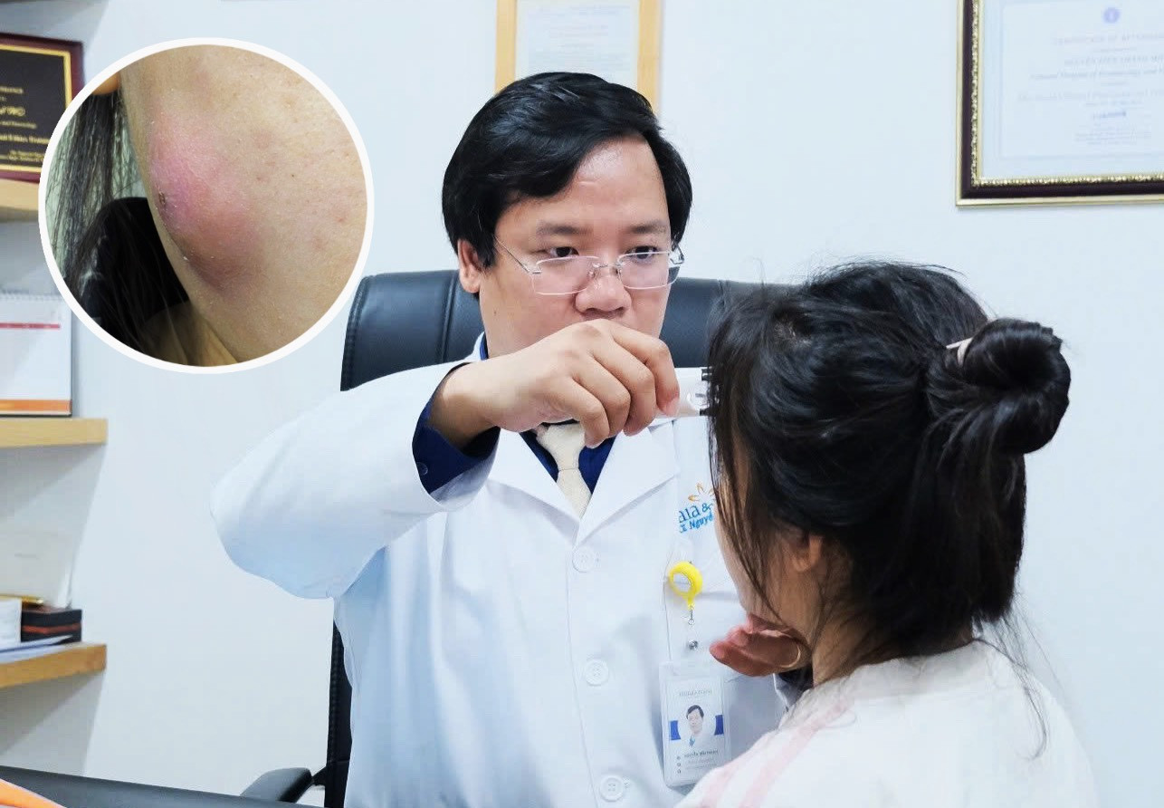 Suýt hoại tử mặt do tự ý nặn mụn