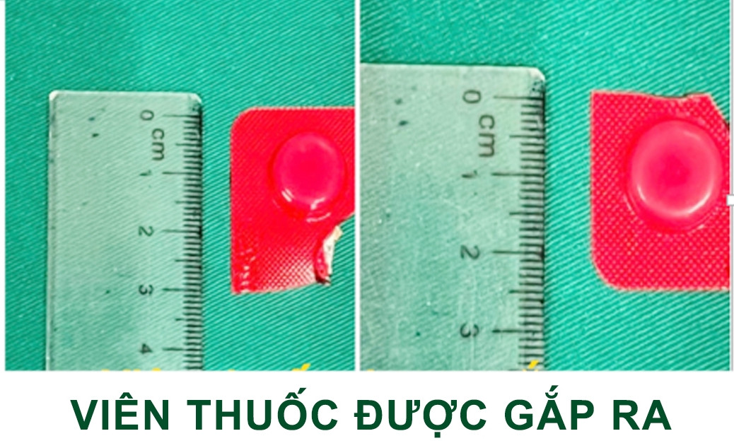 Uống cả nắm thuốc, sơ ý nuốt luôn viên còn nguyên vỏ cứng