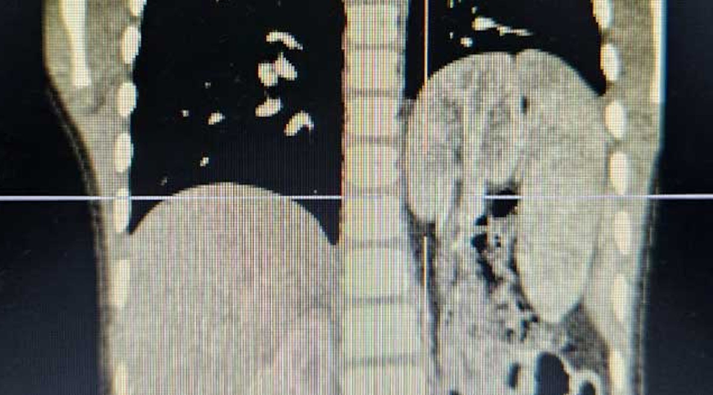 Bé trai nguy kịch do nội tạng chui lên lồng ngực