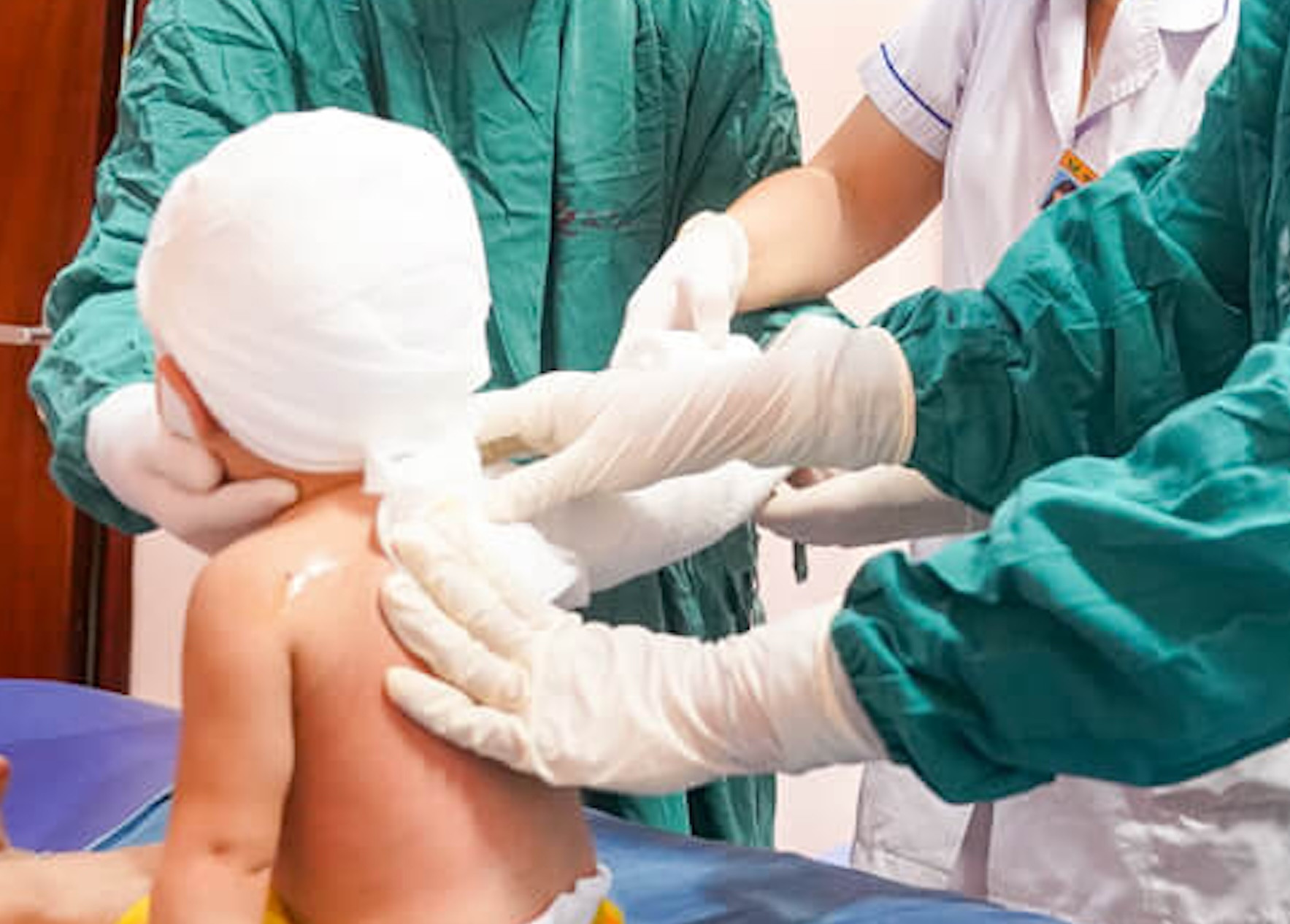 Bé ngã vào bát canh nóng, bôi mỡ trăn khiến bỏng càng nặng: Bác sĩ cảnh báo