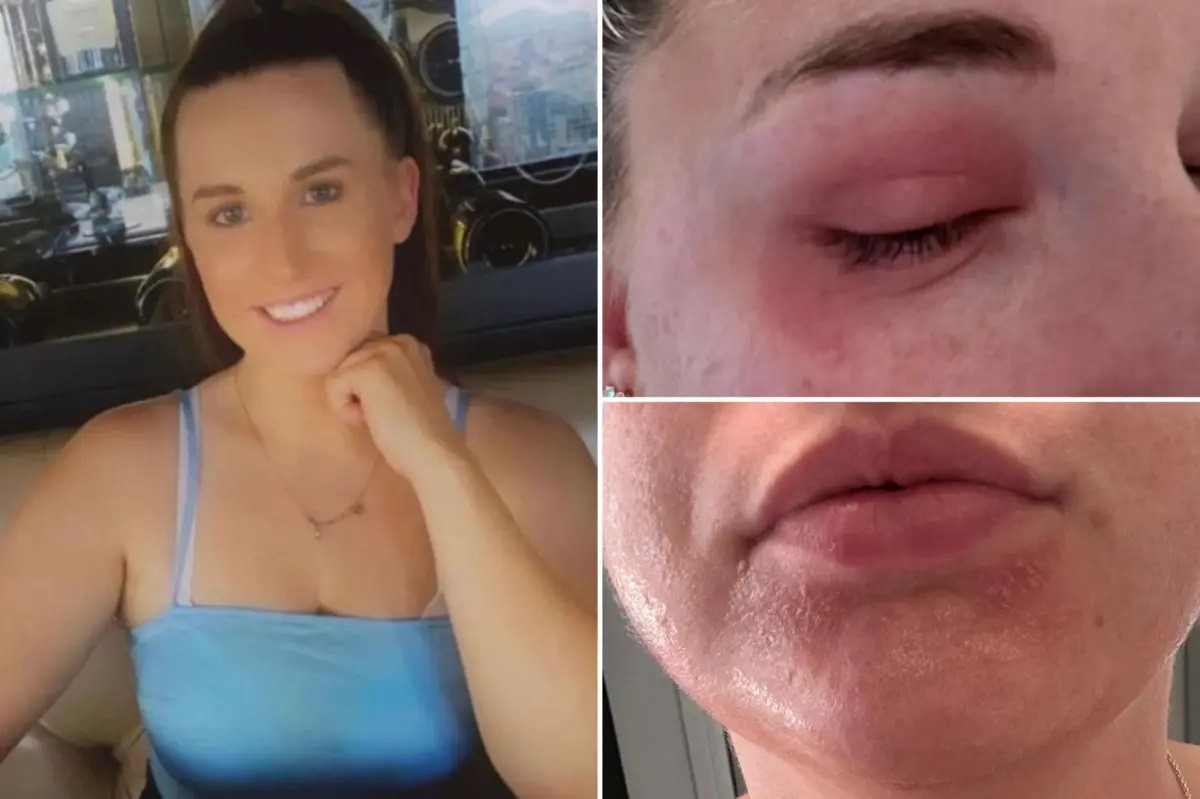 Nỗi khổ của cô gái dị ứng với kỳ kinh nguyệt của chính mình