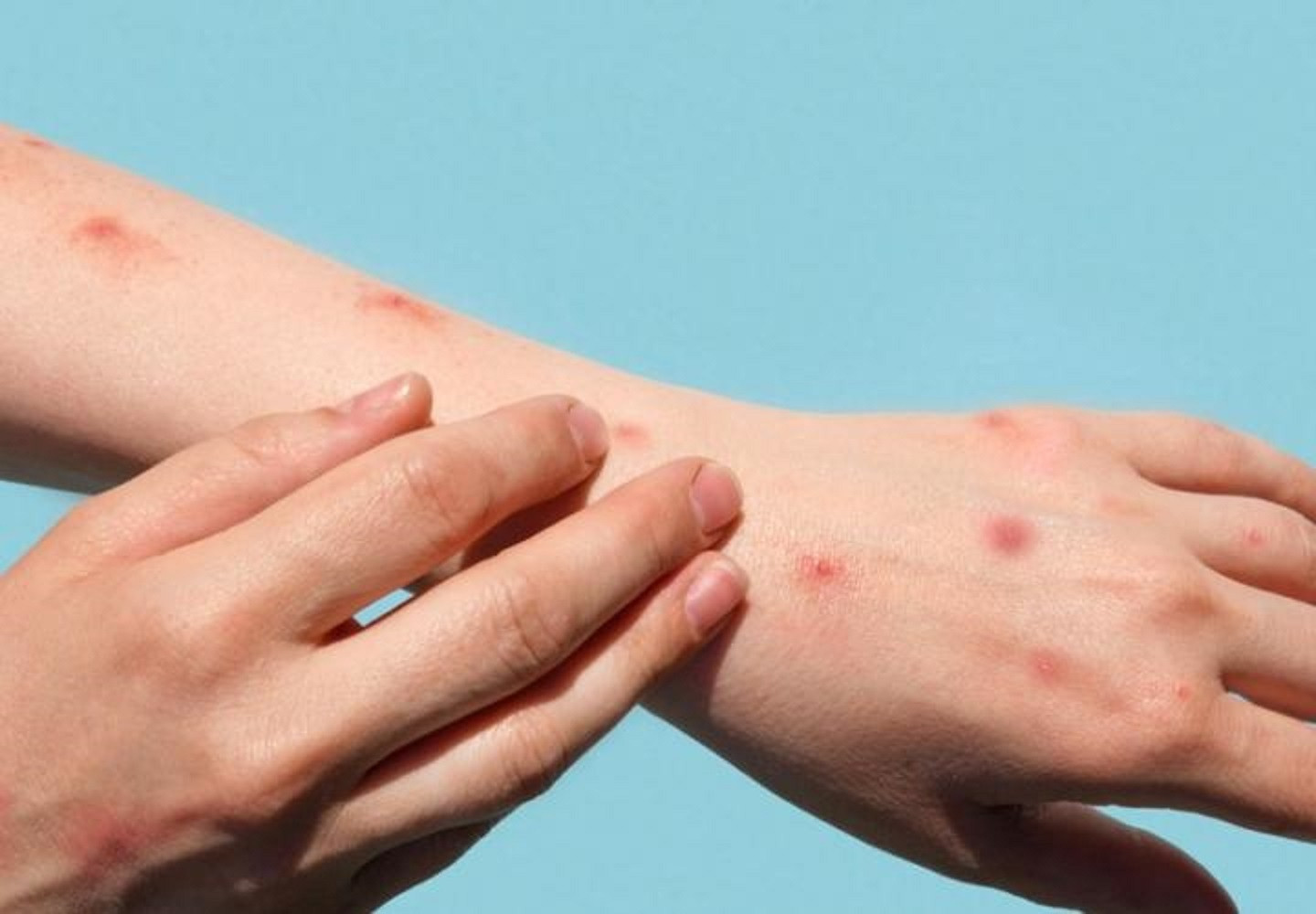 Việt Nam theo dõi sát tình hình dịch bệnh đậu mùa khỉ