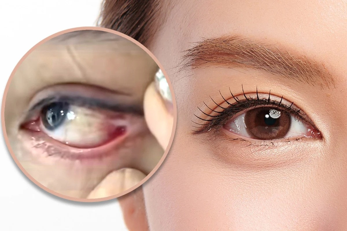 Đi cắt mí, cô gái bị khâu nhãn cầu với khóe mắt, muốn nhìn phải quay đầu 