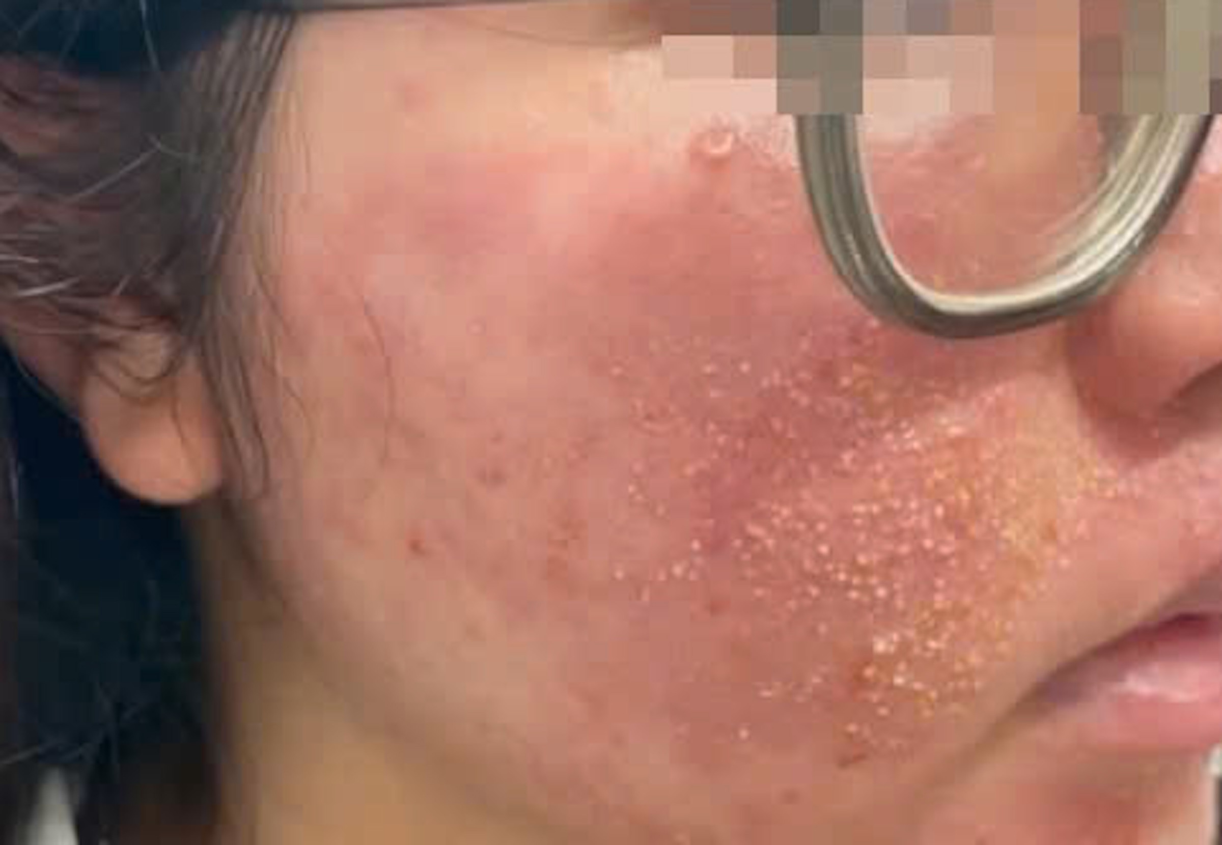 'Nát mặt' vì mua mỹ phẩm trị mụn theo quảng cáo trên mạng