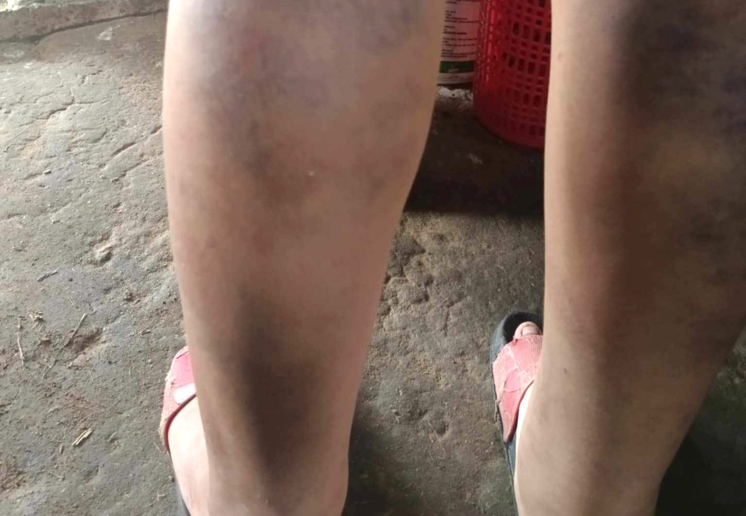 Nam sinh lớp 6 ở Quảng Nam bị cô giáo đánh bầm tím 2 chân