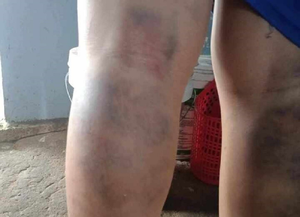 Kỷ luật cảnh cáo cô giáo đánh bầm tím 2 chân học sinh lớp 6