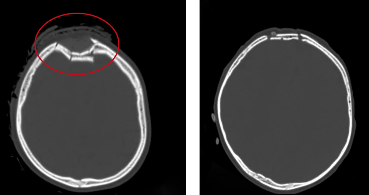 Vô tình vặn tay ga xe máy, trẻ 3 tuổi bị ngã chấn thương sọ não