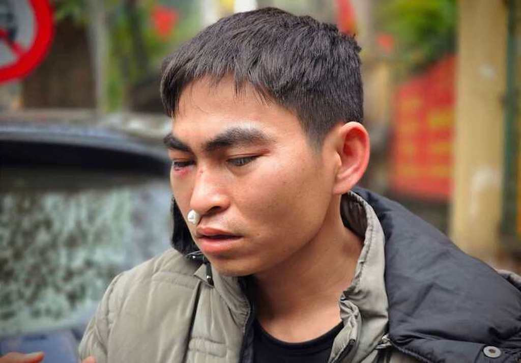 Nam shipper bị tài xế Lexus hành hung gây chấn động não, tỷ lệ thương tích 3%