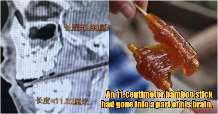 Bị ngã khi ngậm kẹo, cậu bé 6 tuổi bị que kẹo dài 11cm xuyên vào não
