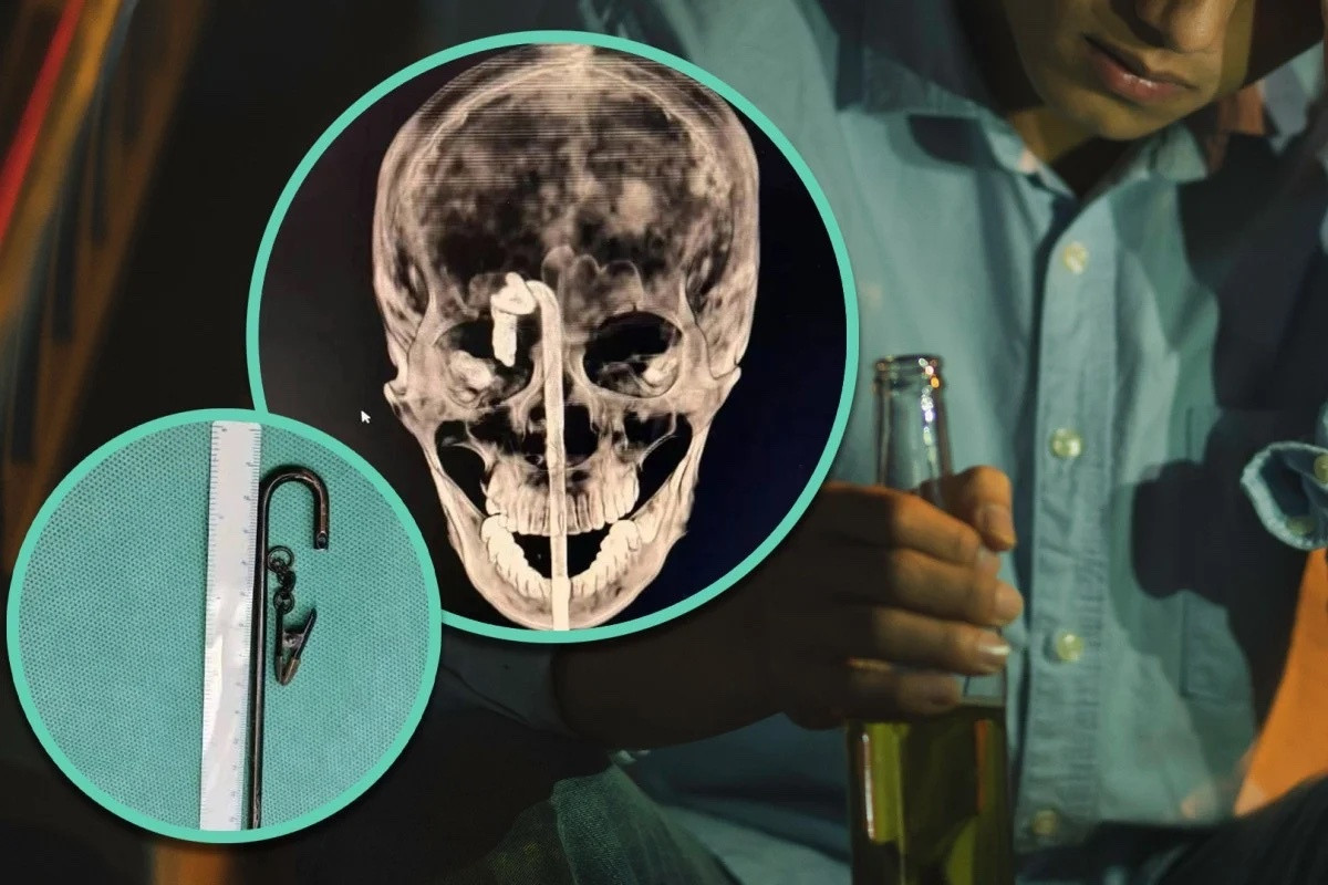 Say rượu ngã trên bàn ăn, người đàn ông bị thanh kim loại đâm xuyên não