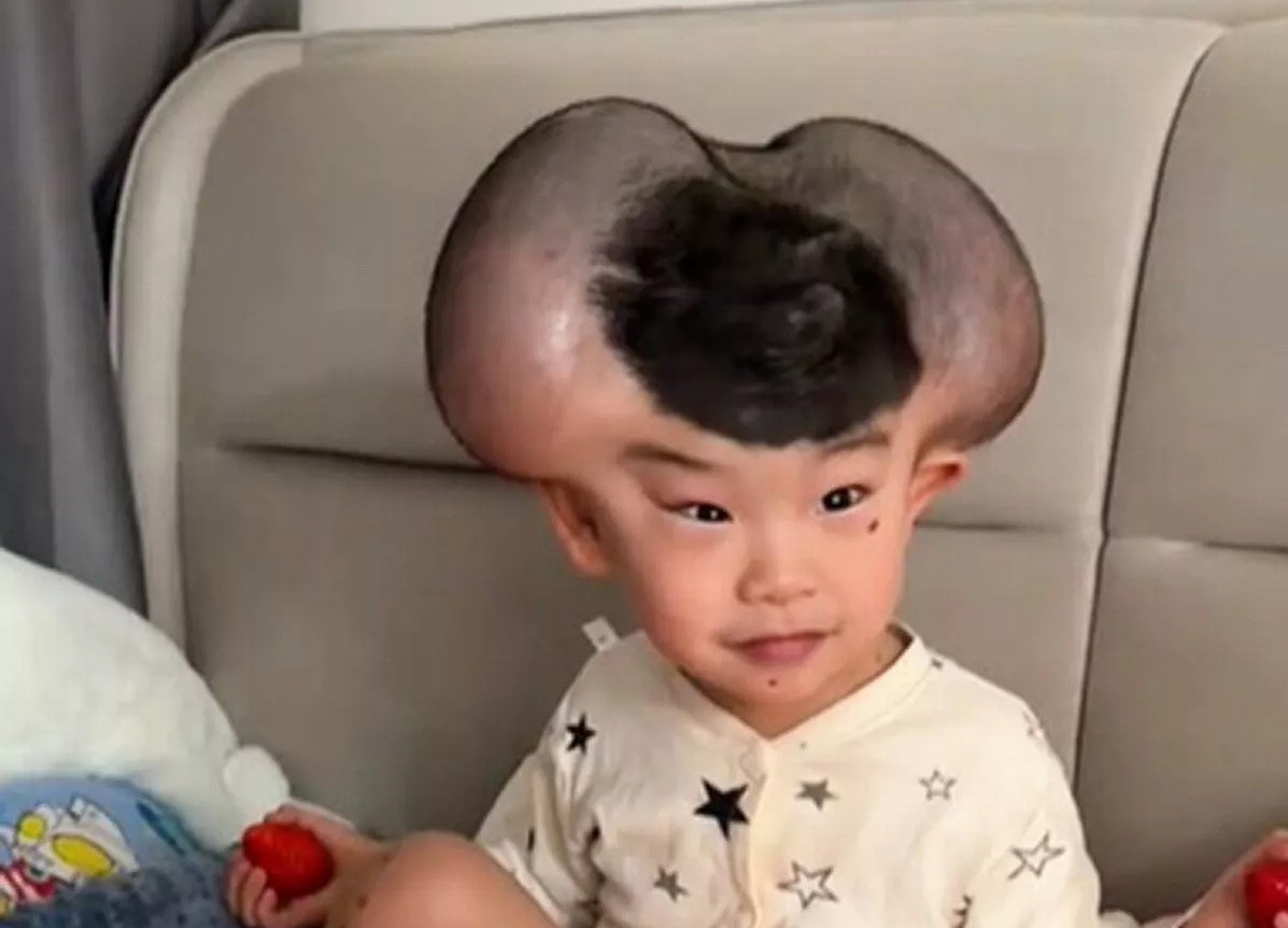 Nốt ruồi khổng lồ phủ kín hộp sọ khiến cậu bé có ngoại hình giống chuột Mickey