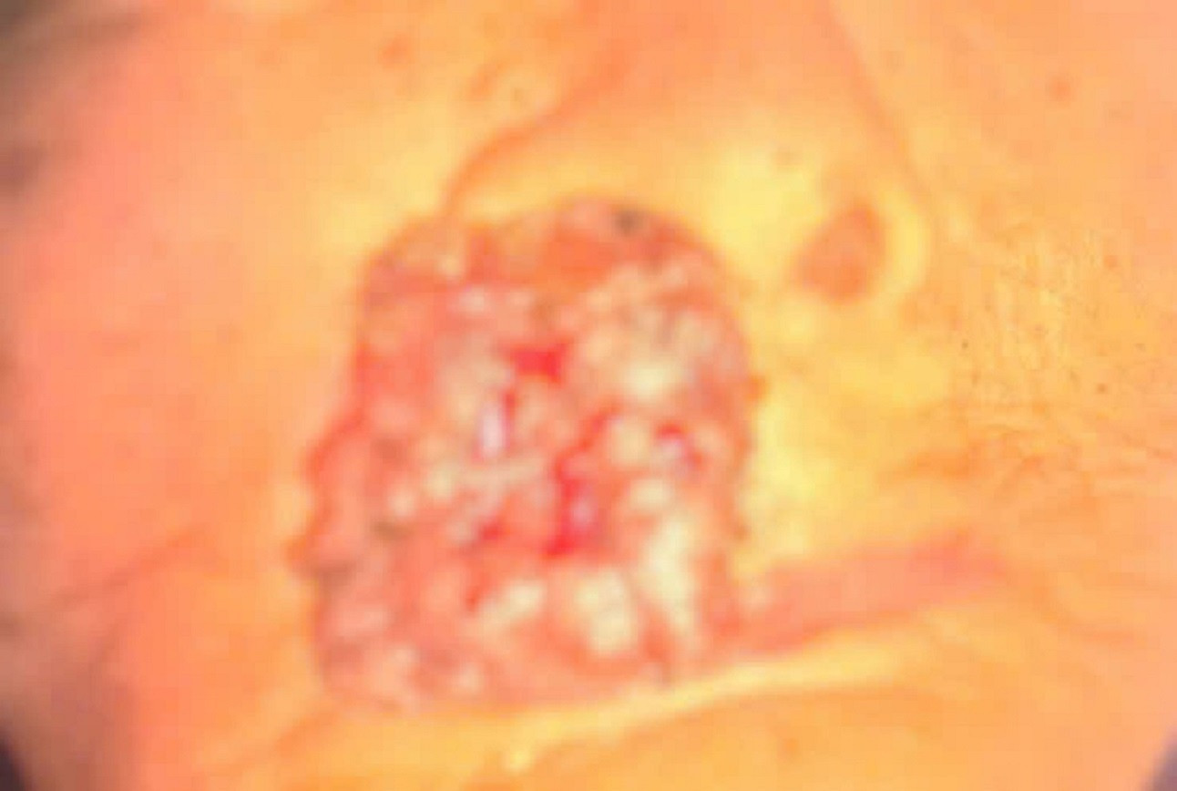 Giòi làm tổ trong khối u trên gương mặt cụ bà 88 tuổi